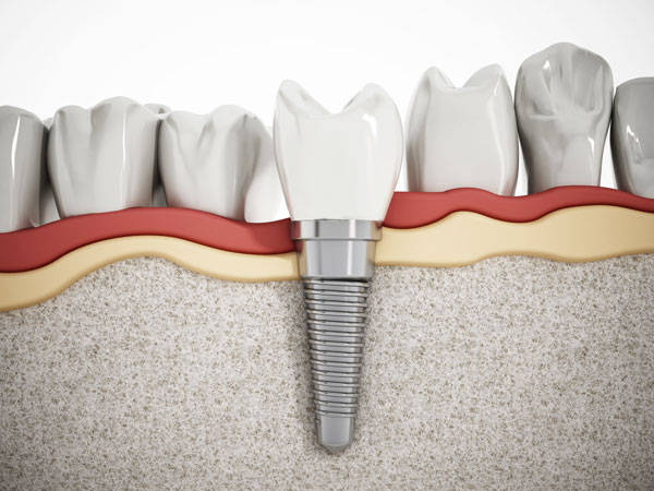 Implantes dentales exitosos