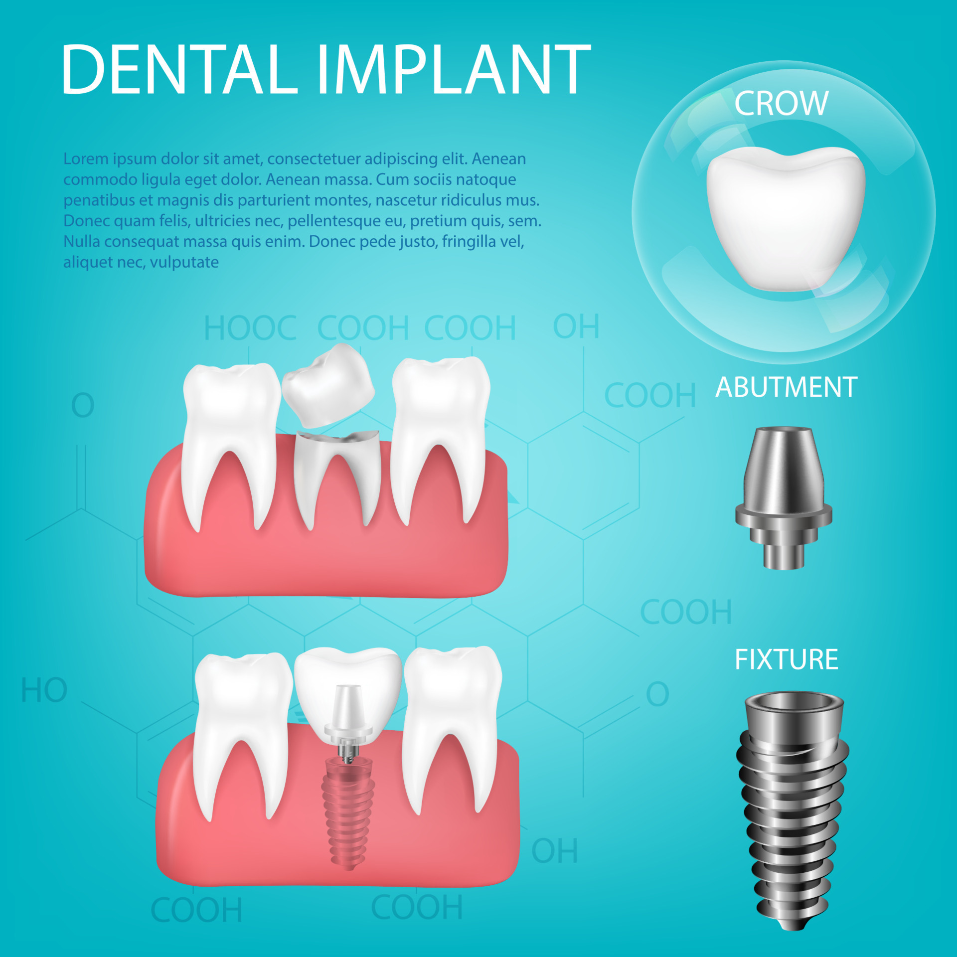 Implantes dentales realistas en 3D