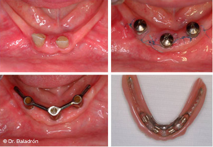 Implante dental fatigado en mandíbula