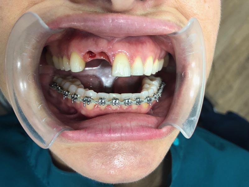 Implantes dentales en simulación